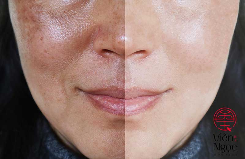 Những bài thuốc Đông Y chữa nám & mụn hiệu quả nhất 1